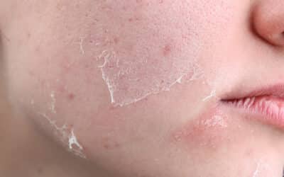 Gesichtsbehandlung bei trockener Haut richtig wählen