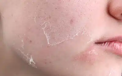 Gesichtsbehandlung bei trockener Haut richtig wählen