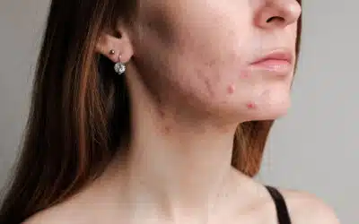 Gesichtspflege bei hormoneller Akne richtig planen
